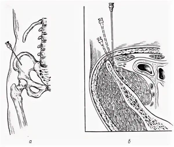Техника внутритазовой блокады по Школьникову Селиванову. Блокада новокаиновая Школьникову Селиванову. Внутритазовая новокаиновая блокада по Школьникову. Внутритазовая новокаиновая блокада по Школьникову Селиванову. Школьникова селиванова