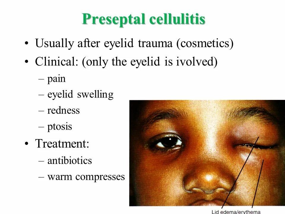 Ptosis латынь. Ptosis латынь