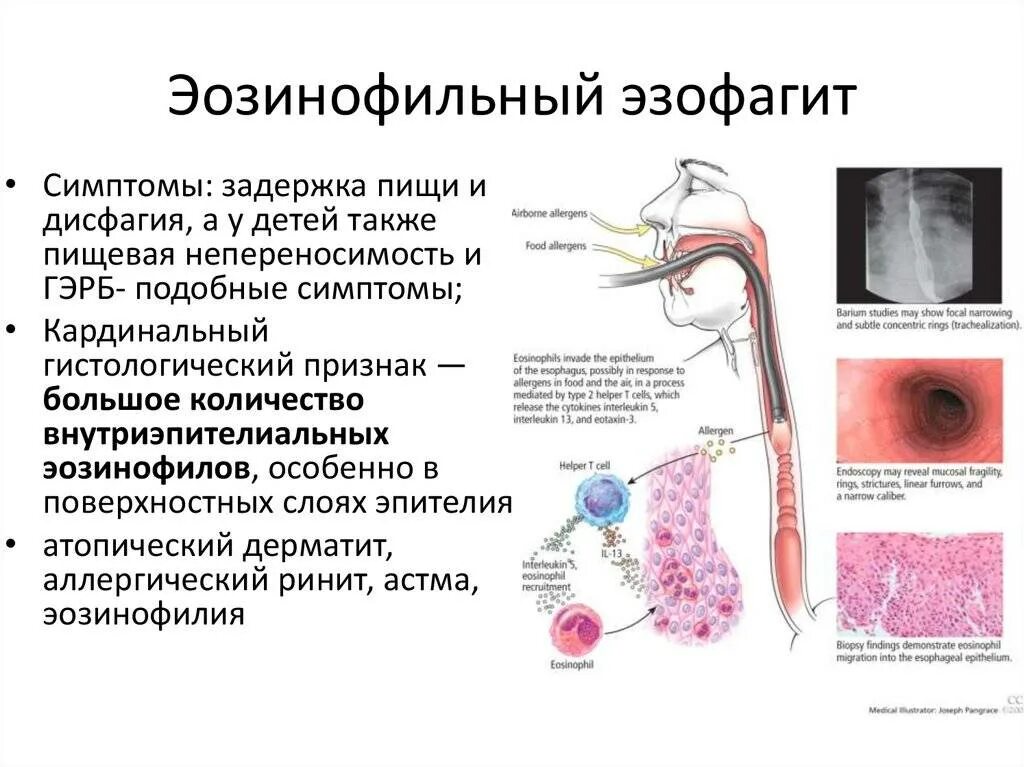 Эрозивный эзофагит классификация. Классификация эзофагитов патанатомия. Эндоскопическая классификация эозинофильного эзофагита. Рефлюкс эзофагит патанатомия. Патогенез эозинофильного эзофагита.