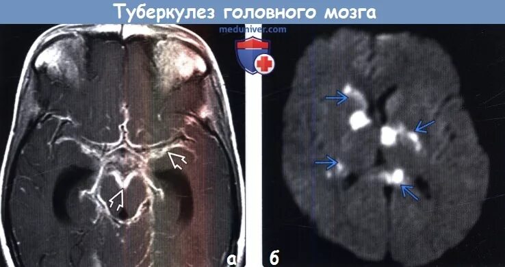 Мозговой туберкулез