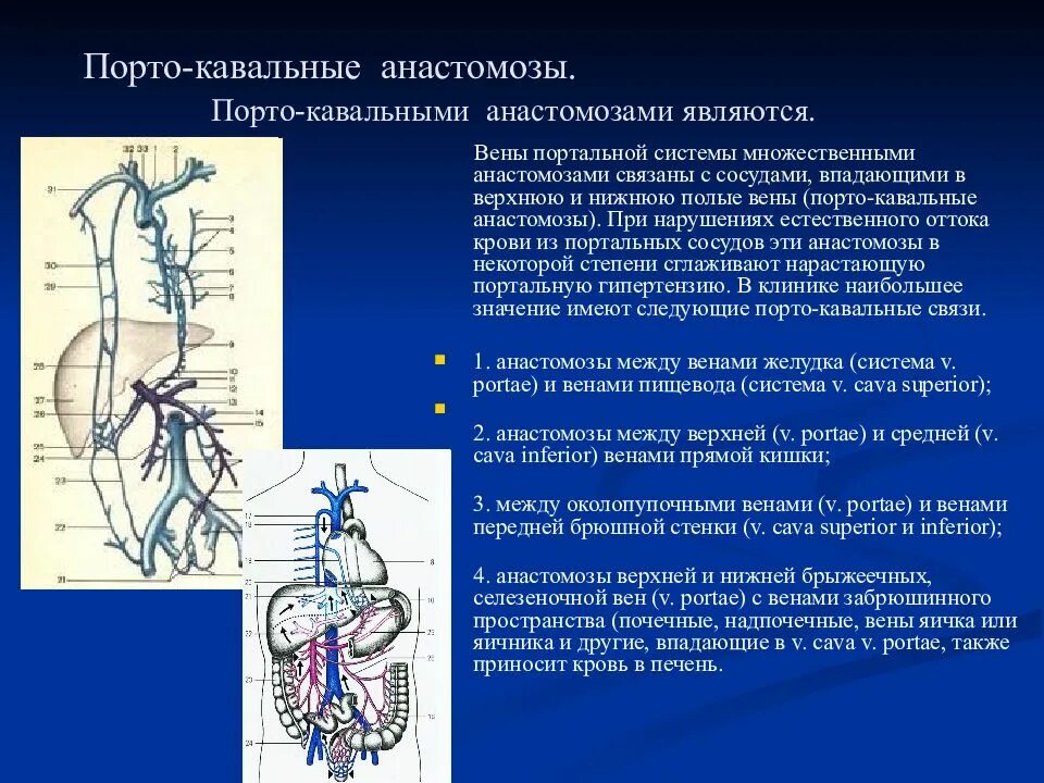 Портальная гипертензия воротной вены. Нижняя брыжеечная Вена анастомозы. Анастомозы нижней полой вены (кавакавальные).. Портокавальный анастомоз с воротной Веной.