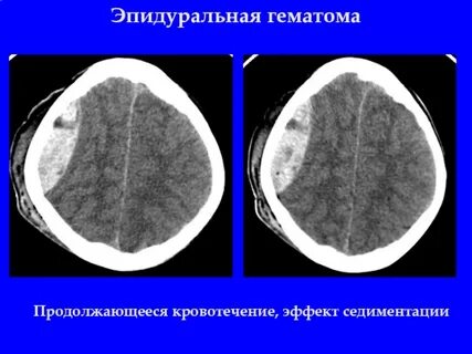 Черепно мозговая травма гематома
