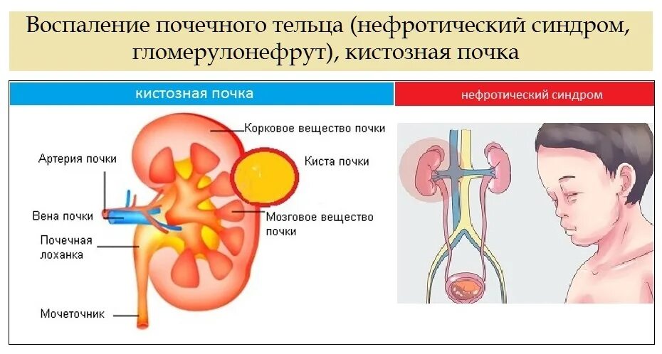 Синдром тельца. Нефротический синдром поражение клубочков. Почки при нефротическом синдроме. Заболевания почек с нефротическим синдромом. Хронические заболевания почек с нефротическим синдромом.