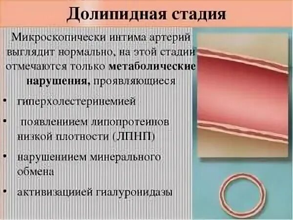 Долипидная стадия атеросклероза. Атеросклероз долипидная стадии патанатомия. микроскопические стадии атеросклероза. стадии атеросклероза долипидная стадия. стадии атеросклероза патанатомия.
