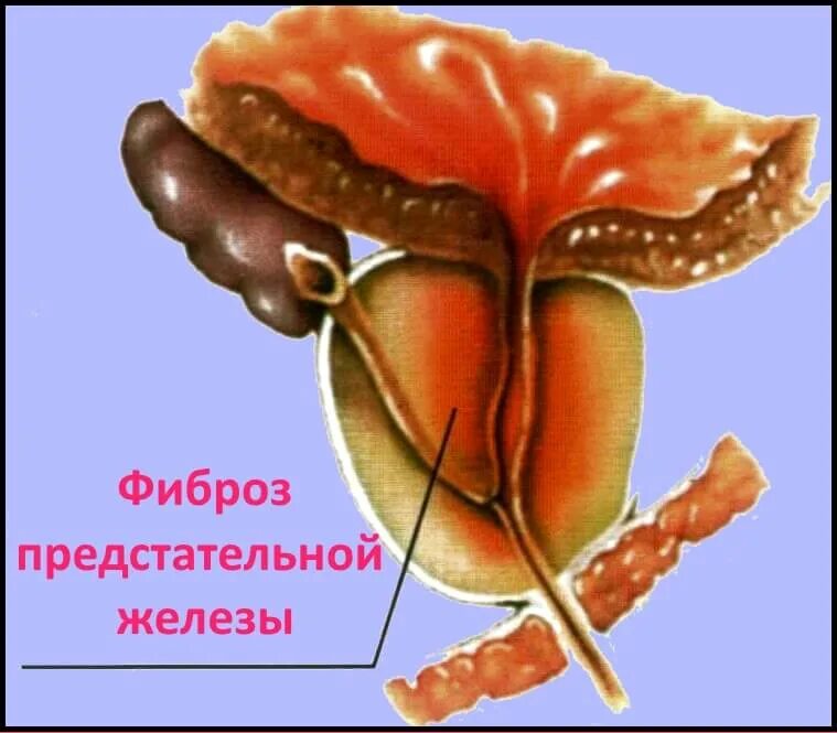 Фиброзные изменения предстательной железы. Фиброз аденомы предстательной. фиброз в предстательной железе. рубец предстательной железы.