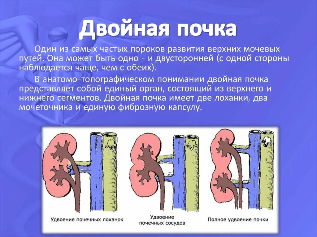 Удвоение почки. Удвоение почки у человека. Сдвоенные почки у человека.