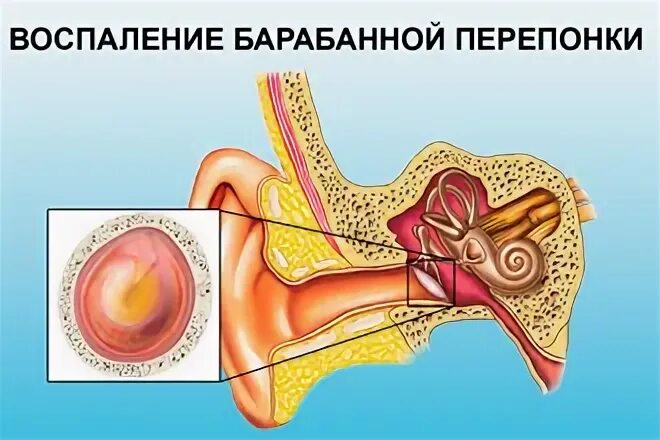 Заложенность в ушах при простуде