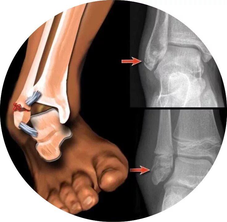 Голеностопный сустав сколько заживает. Разрыв связок голеностопного сустава рентген. Пронационный перелом лодыжки. Растяжение голеностопа рентген. Перелом голеностопа гематома.