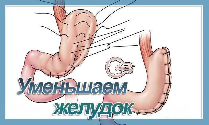 Объём желудка взрослого человека. Объем желудка. Как уменьшить размер желудка. Уменьшить объем желудка. Как уменьшить размер желудка.