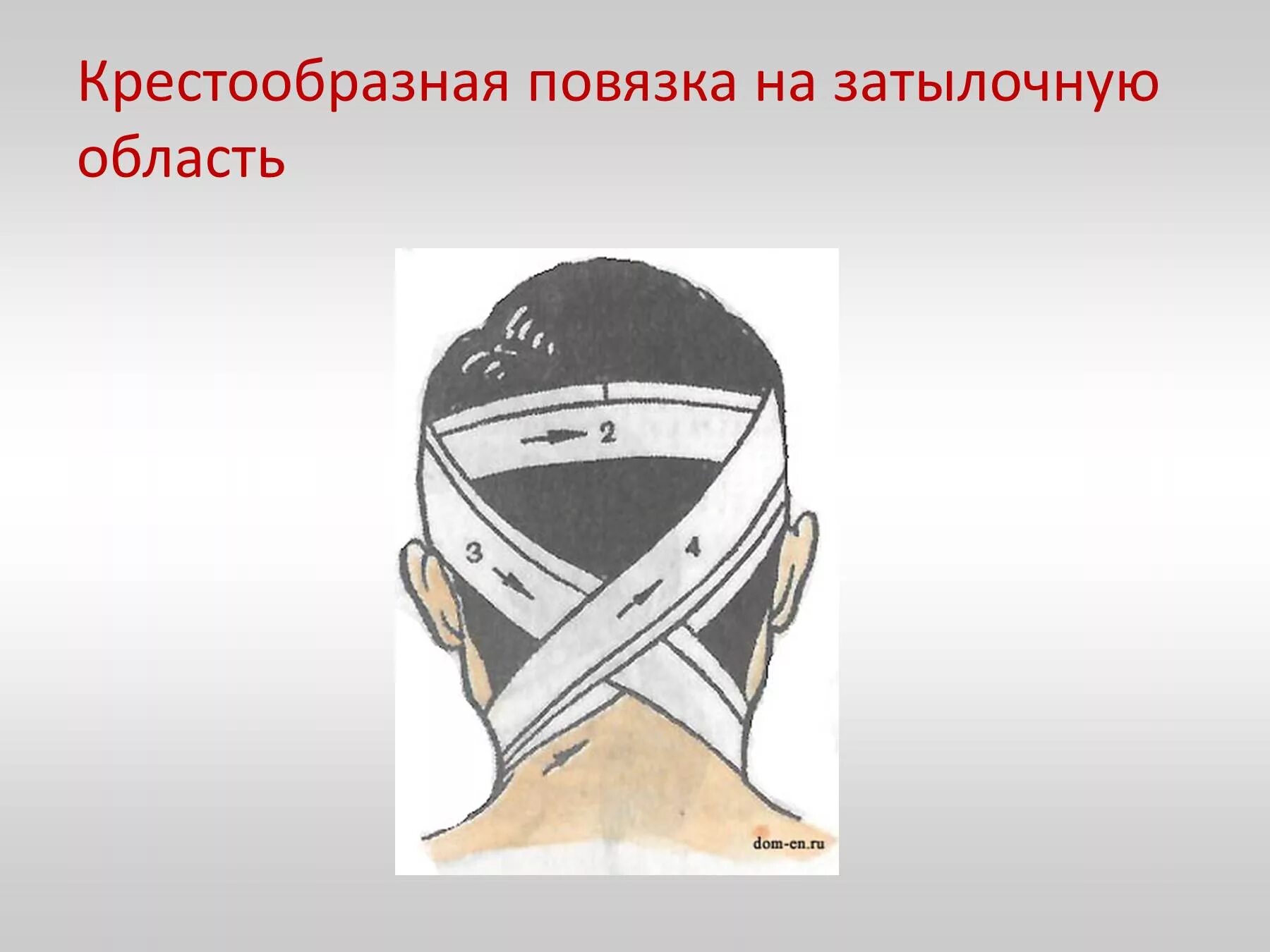 Крестообразная повязка. Крестообразная повязка на затылок спереди. Крестообразная повязка показания. Техника наложения повязки на затылочную область. Крестообразная десмургия.