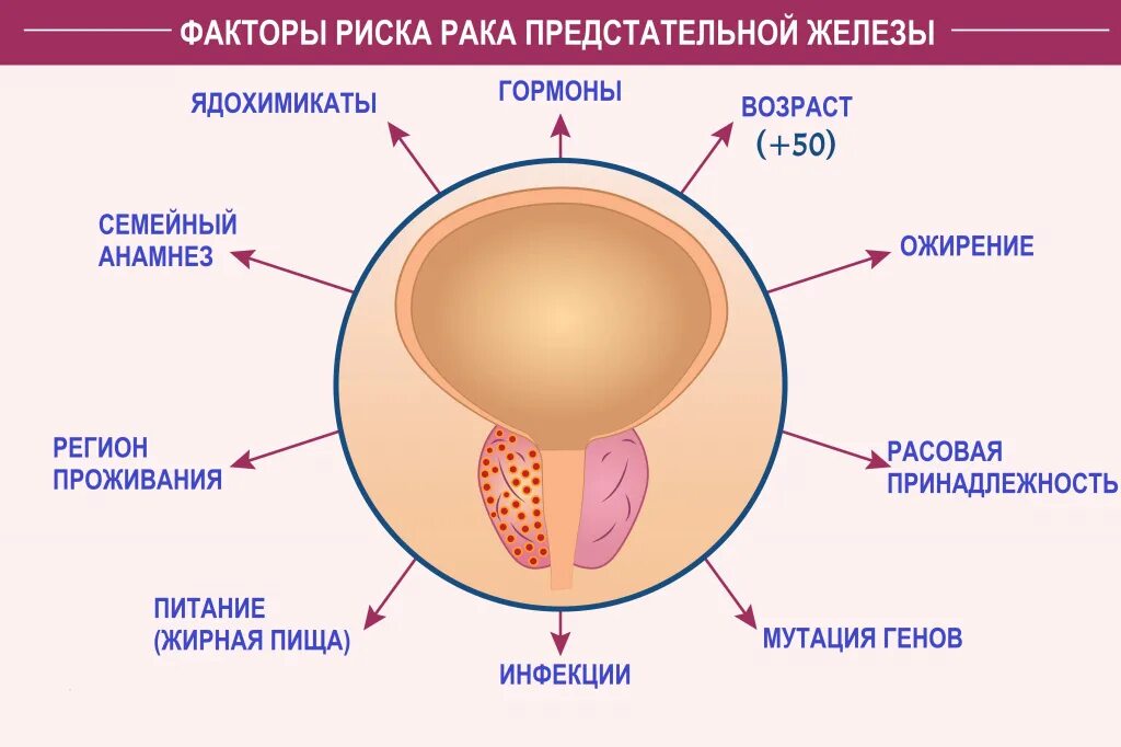 Ткани простаты. Ткани предстательной железы. Злокачественное новообразование предстательной железы с61 что это. Как выглядеитна схеме раковая опухоль яйца.
