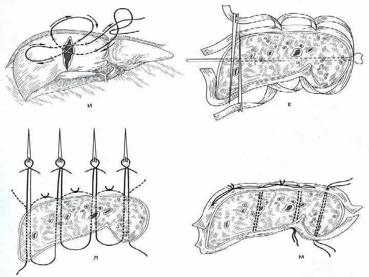 Ушивание разрывов. Ушивание РАН паренхиматозных органов. Шов Кузнецова-Пенского на печени. Паренхиматозный матрацный шов.