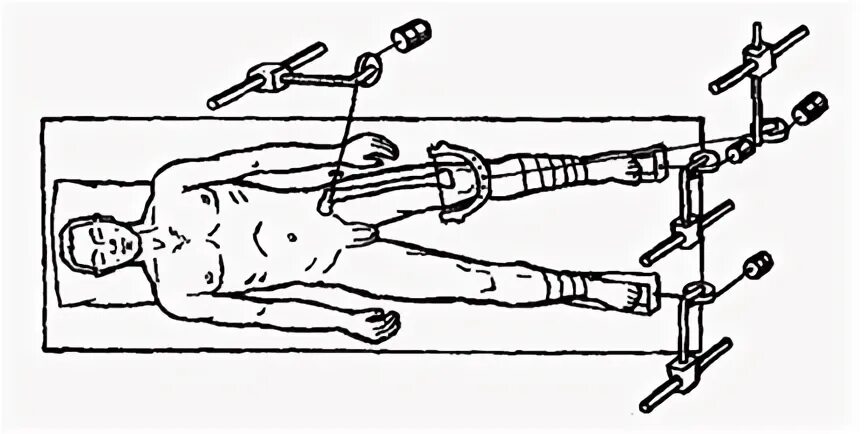 Лфк при реабилитации после перелома шейки бедра. Переломы костей таза с повреждением тазовых органов. Скелетное вытяжение костей таза. Перелом с нарушением тазового кольца. Перелом костей таза принципы лечения.