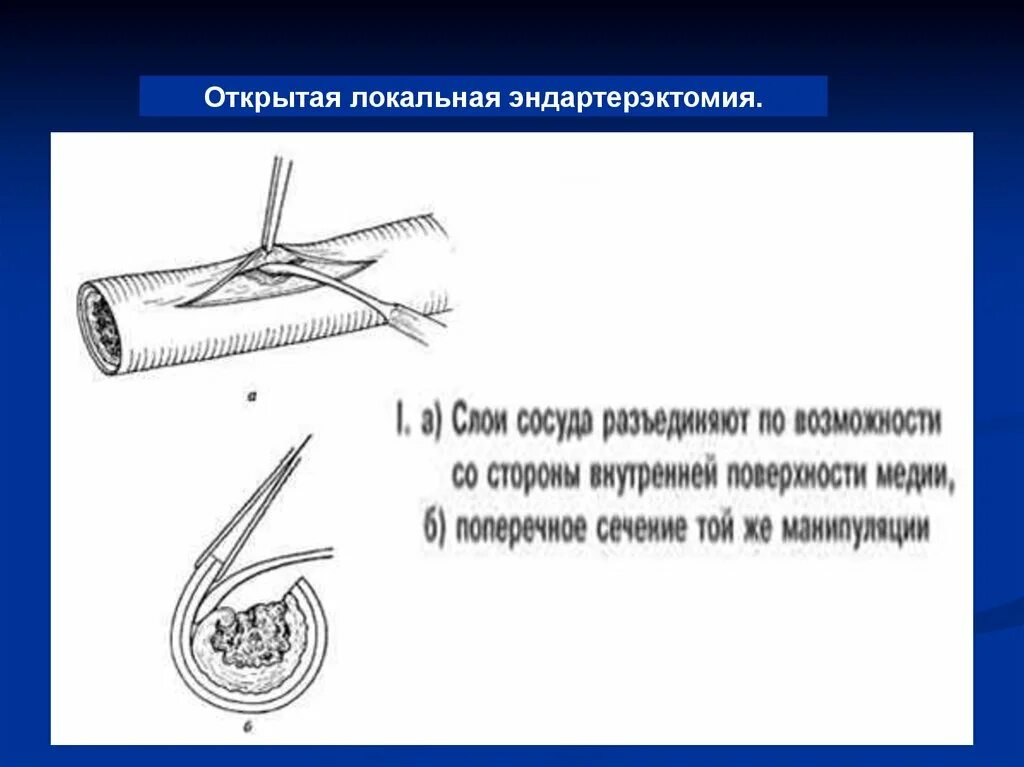 Эндартерэктомия это. Эверсионная эндартерэктомия. Каротидная эндартерэктомия ход операции. Эндартерэктомия с пластикой артерии. Эндартерэктомия Оперативная хирургия.