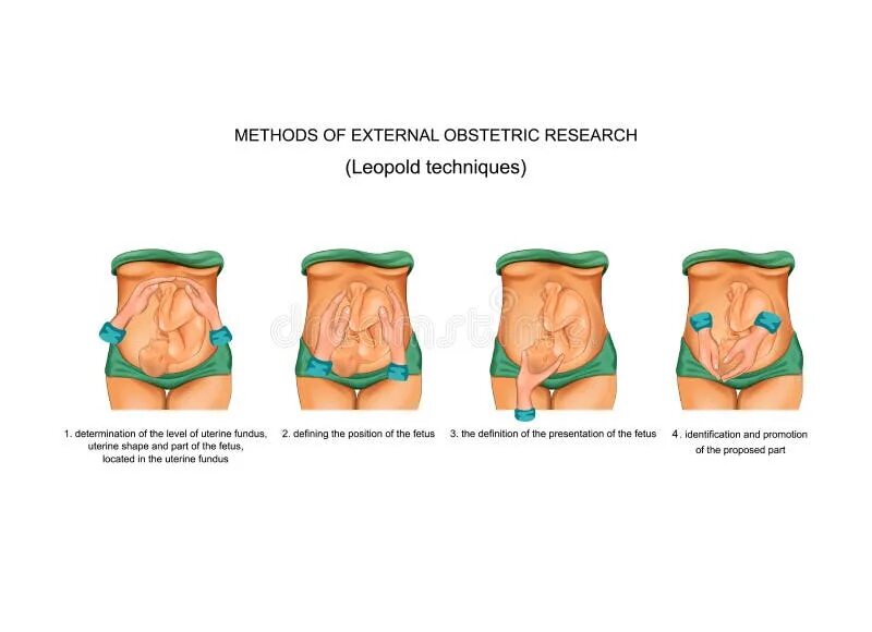 Приемы леопольда алгоритм. 4 Приема Леопольда Левицкого в акушерстве. Приёмы Леопольда Левицкого в акушерстве 4 прием. Метод Леопольда Левицкого в акушерстве.