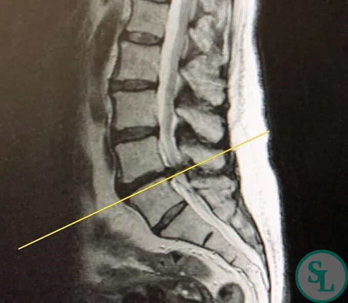 Остеохондроз поясничного отдела l5 s1. Стеноз позвоночного канала l5-s1. Грыжи дисков l4-l5 l5-s1. Корешковый синдром l4.