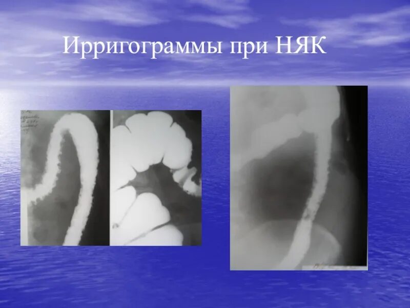 Больные няком. Язвенный колит гранулемы. Хронический неспецифический язвенный колит. Язвенно некротический колит. Неспецифический язвенный колит рентген.