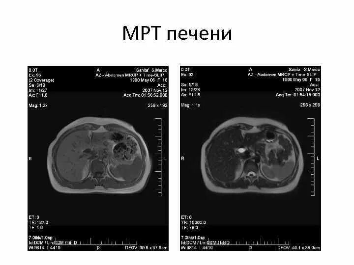 Сегменты печени на кт анатомия. Сегменты печени мрт схема. Сегменты печени мрт кт. Кт норма печень