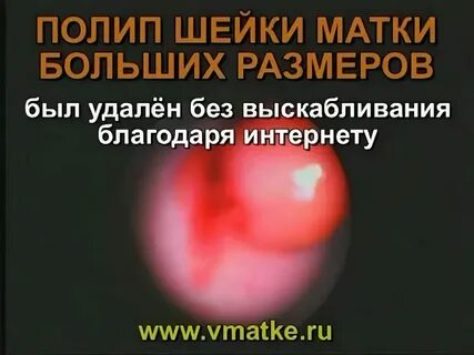 Полип матки операция отзывы