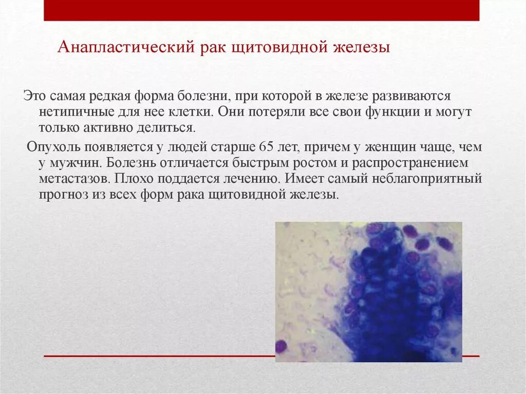 Метастазы при раке щитовидной железы