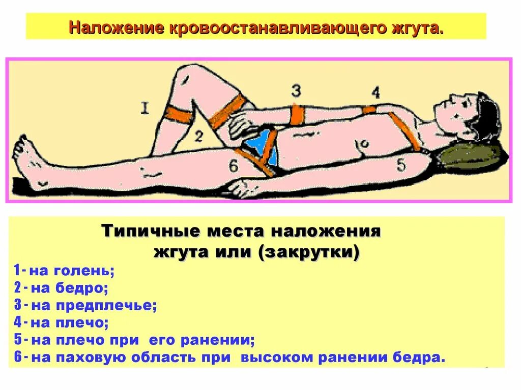 техника наложения кровоостанавливающего. техника наложения кровоостанавливающего. наложение жгута при кровотечениях. наложение артериального кровоостанавливающего жгута. правила наложения кровоостанавливающего жгута.