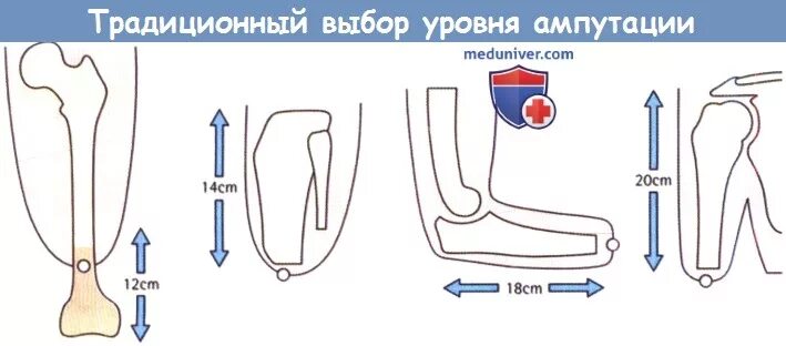 Выбор уровня ампутации. Протез ноги чертеж. Уровни ампутации нижней конечности.