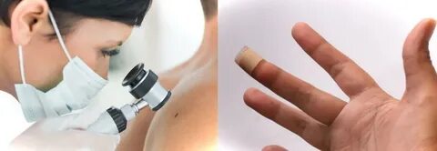 Кровоточащий удаление