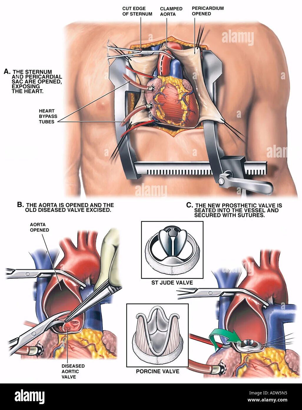 Инвалидность после замены клапана. Протезирование аортального клапана операция. Операция на сердце аортальный клапан. Операции на о крытом сердце. Операция на сердце замена клапана.