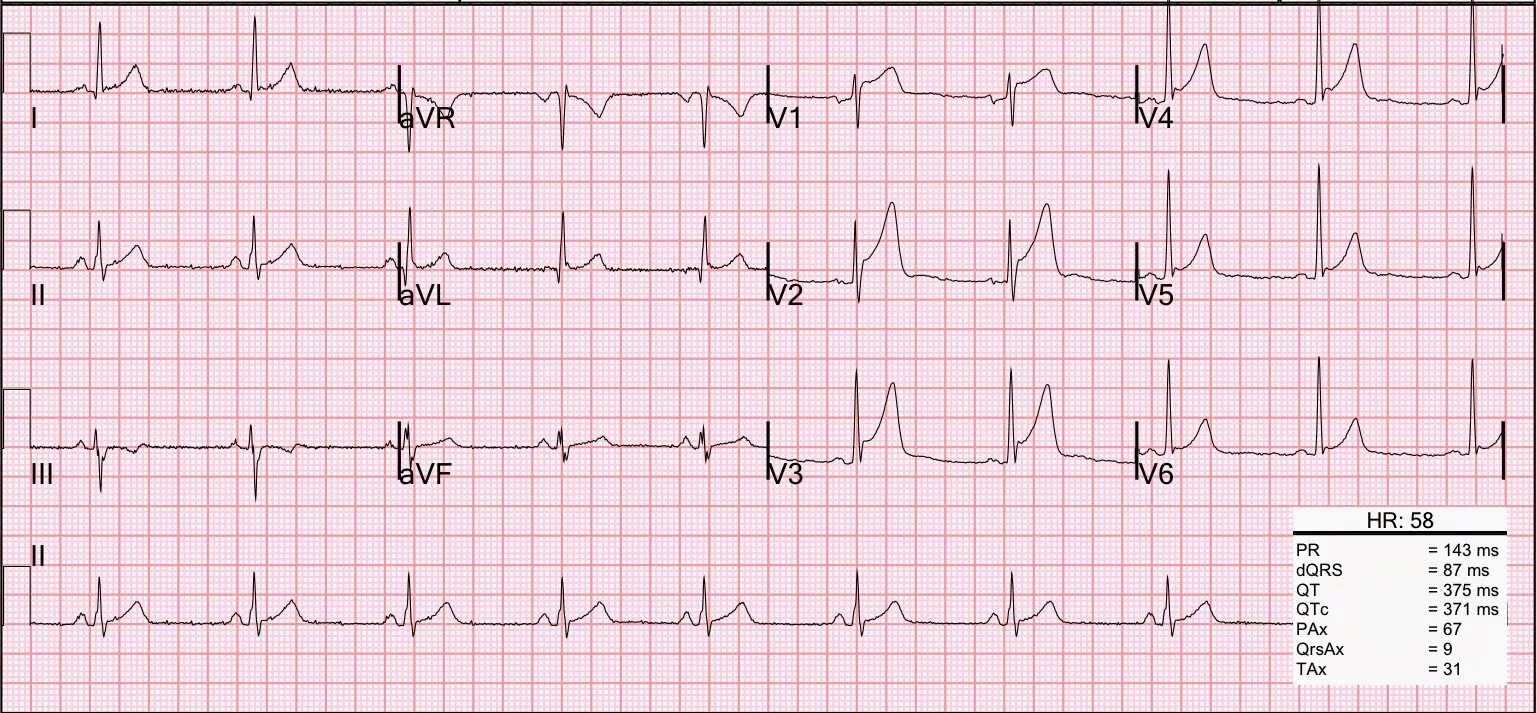 V4 v5 v6 на ЭКГ. ЭКГ электрокардиограмма сердца. Нижний STEMI на ЭКГ. Снимок ЭКГ У здорового человека. Тяжелое экг