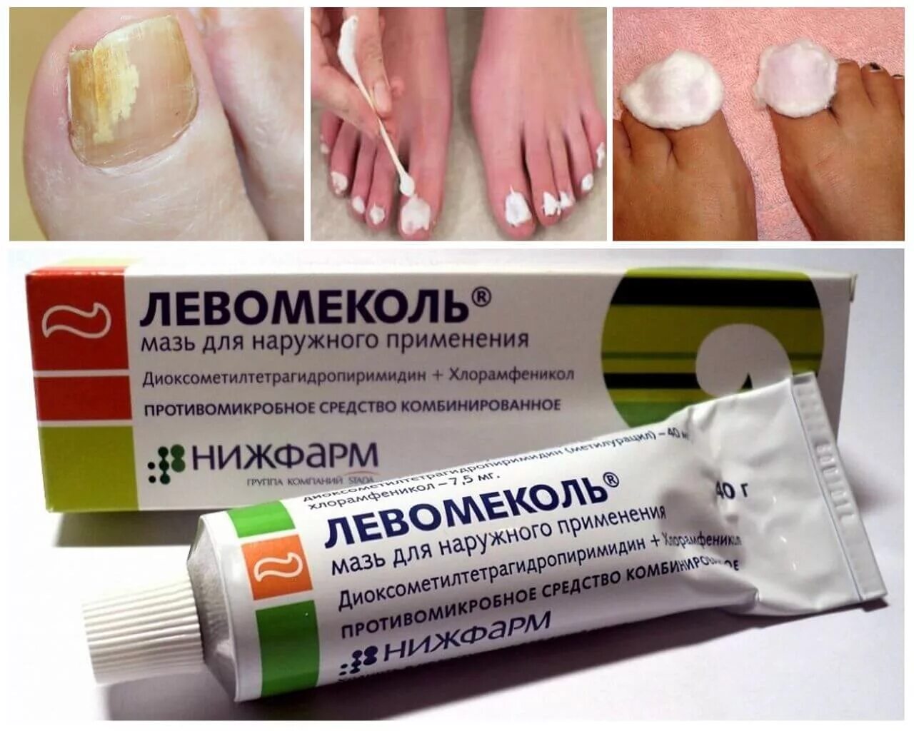 Самое сильное средство от грибка на ногах