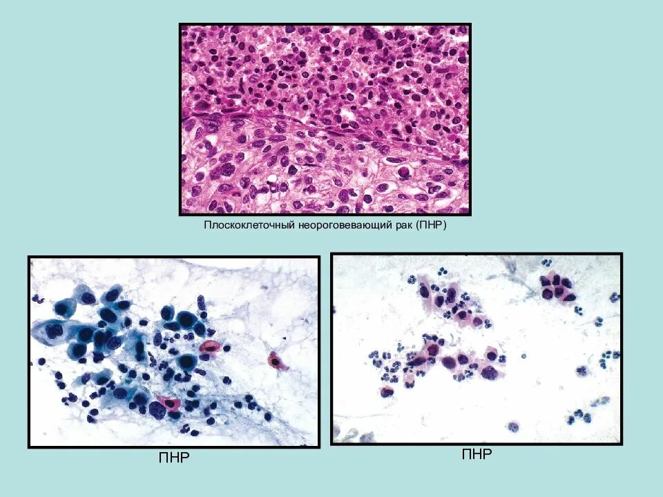"Цитологическая диагностика заболеваний лёгких" Шапиро. Плоскоклеточный неороговевающий. Плоскоклеточная карцинома гистология. Цитологическая картина плоскоклеточной карциномы. Плоскоклеточный неороговевающий рак шейки