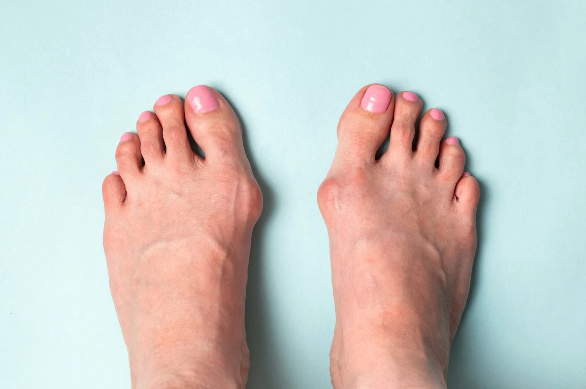 Стопы какой врач. Деформация hallux valgus вальгусная. Hallux valgus (косточки на стопе).