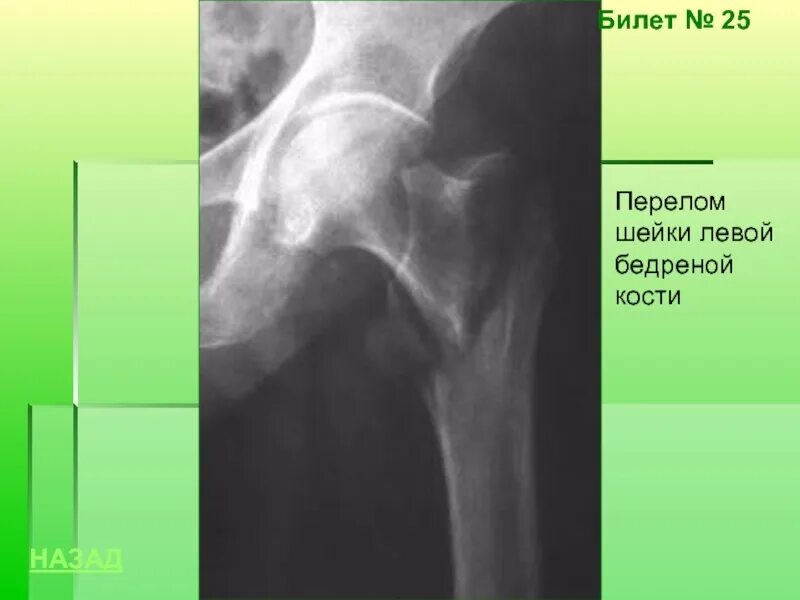 Субкапитальный перелом шейки левой бедренной кости. Вколоченный перелом шейки бедренной кости рентген. Субкапитальный перелом шейки бедра рентген. Вколоченный перелом шейки бедра рентген. Шейки левого бедра