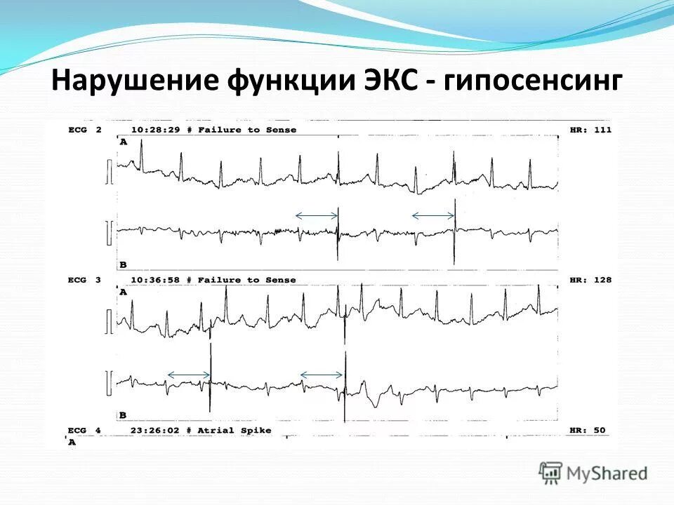 Нарушение детекции экс. Функция детекции. Нарушение функции детекции экс. Гиперсенсинг экс. Виды детекции.
