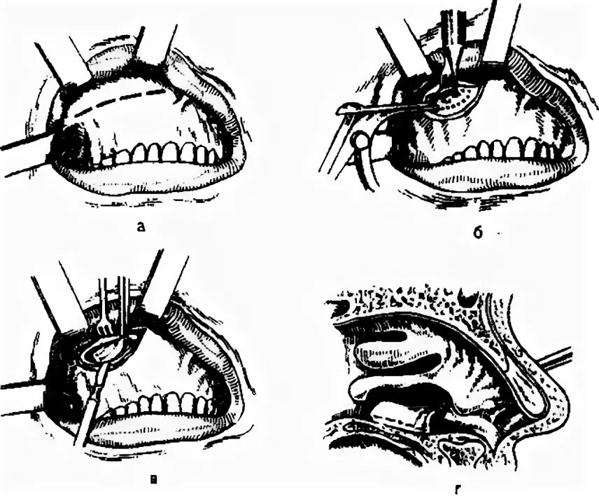 операции верхнечелюстной синусит