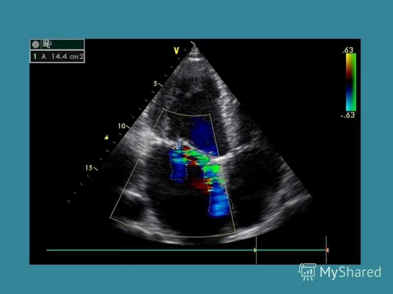 Внутрисердечный ультразвук. Обследование сердечно сосудистой системы. Узи сердца аритмии. Аритмия у детей. Транспищеводная эхокардиография (тпэ.
