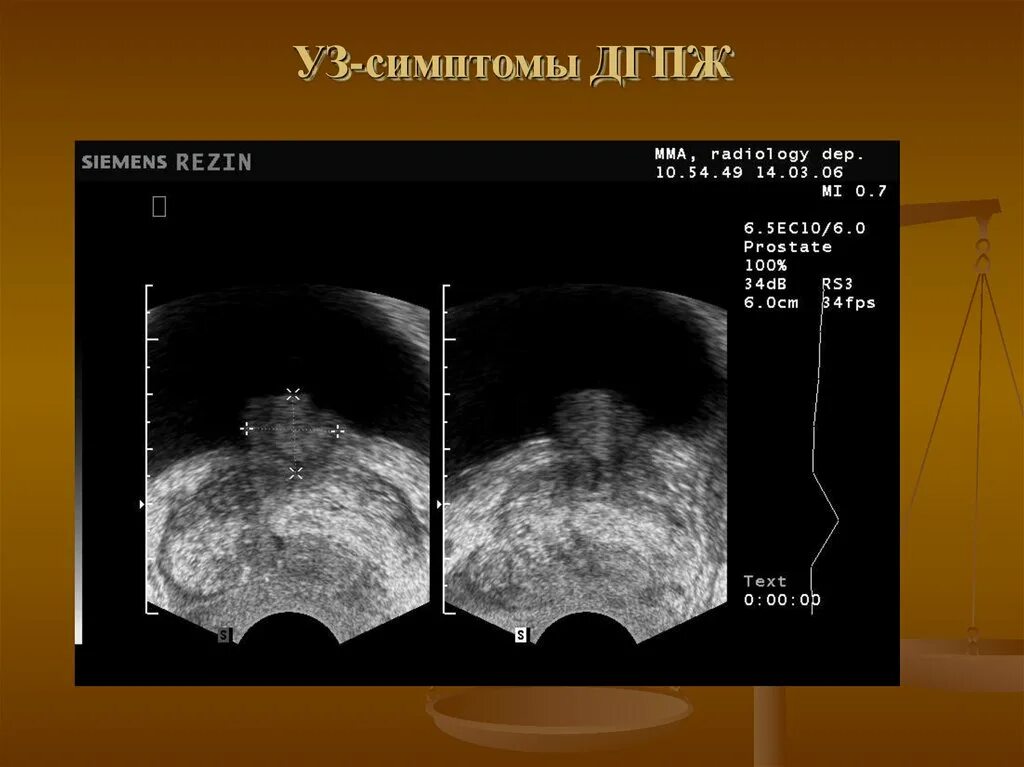 Что значит дгпж. УЗИ доброкачественная гиперплазия предстательной железы. УЗИ предстательной железы при ДГПЖ. Аденома предстательной железы на УЗИ.