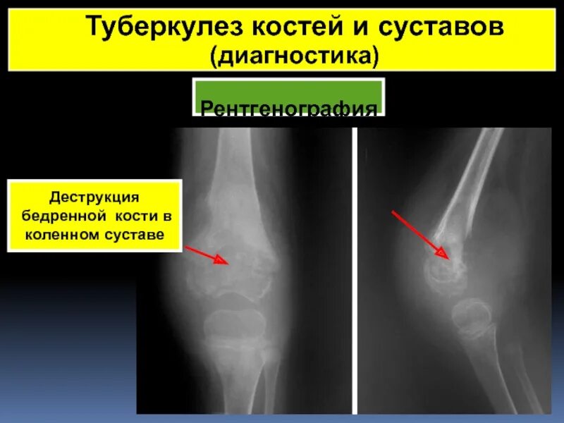 Коленный туберкулез