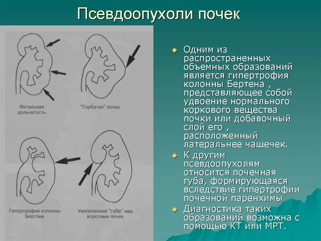 Почечная колонка Бертена. Гипертрофия колонны Бертена. Гипертрофированная колонна Бертини почки что это. Горбатая почка