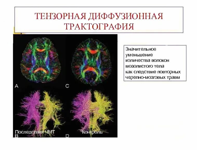 Трактография головного мозга. Трактография мрт. Диффузионная трактография. Мрт трактография мозга.