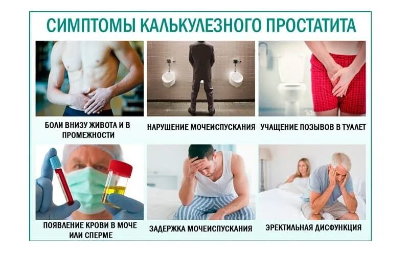 Калькулезный простатит симптомы