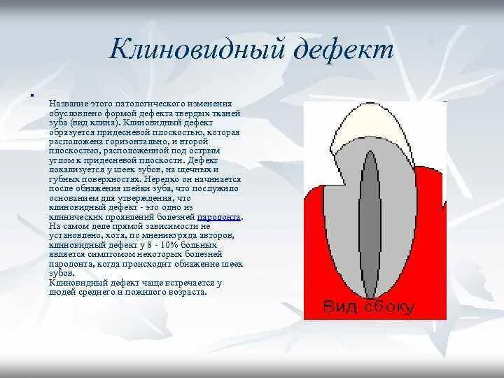 Клиновидный причины. Клиновидный дефект эмали. Клиновидный дефект на резцах. Пришеечный кариес пломба. Клиновидный дефект этиология.