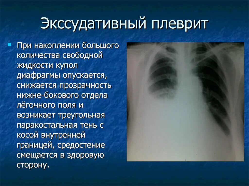 Болезни плевры