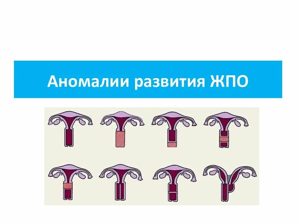 Аномалии женских половых. Аномалии развития половых органов. аномалии развития женских органов. пороки развития женских половых органов. классификация аномалий развития женских органов.
