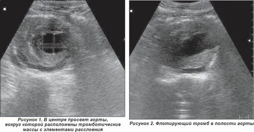 Тромбоз брюшной. Расслаивающаяся аневризма аорты УЗИ. Расслаивающаяся аневризма брюшной аорты по УЗИ. Диссекция аорты ЭХОКГ. Расслаивающаяся аневризма брюшной аорты на УЗИ.