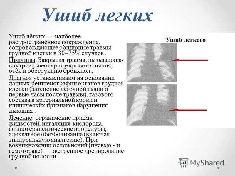 Закрытая травма легкого