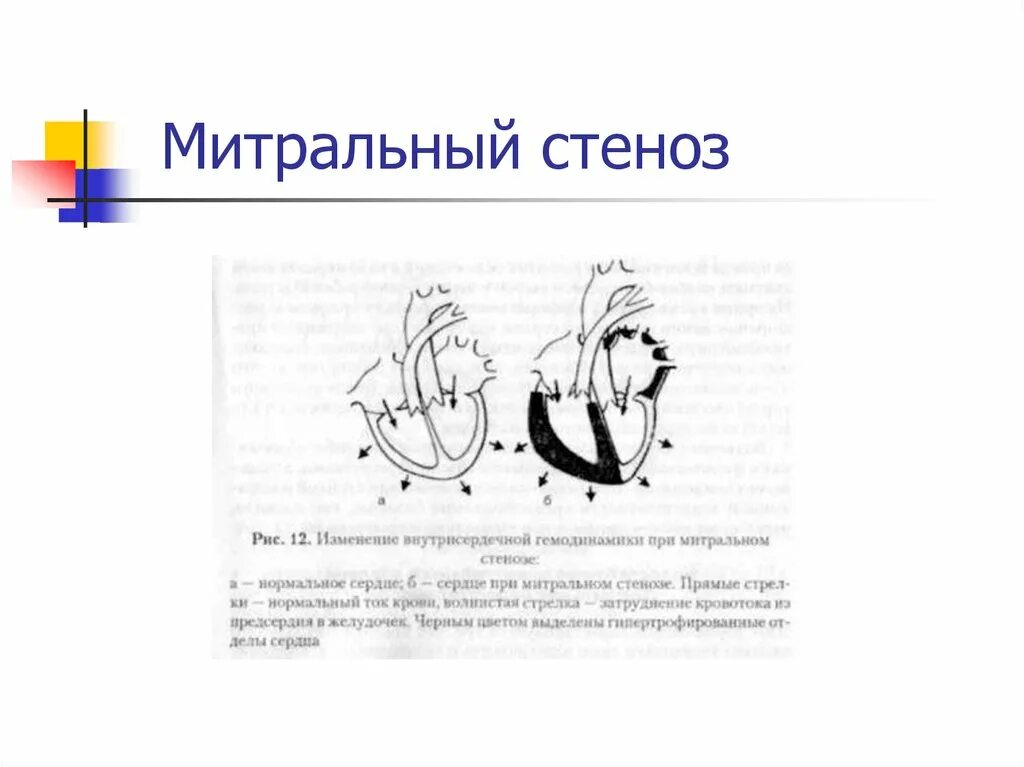 При митральном стенозе наблюдается. Стеноз митрального отверстия гемодинамика. стеноз митрального отверстия схема. гемодинамика при митральном стенозе. митральный стеноз рисунок схема.
