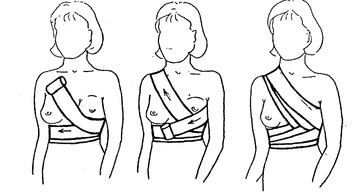 Повязка на молочные железы алгоритм. Накладывание повязки на молочную железу. Повязка молочной железы техника наложения. Наложение повязки на молочную железу алгоритм. Бинтовая повязка поддерживающая на молочную железу.