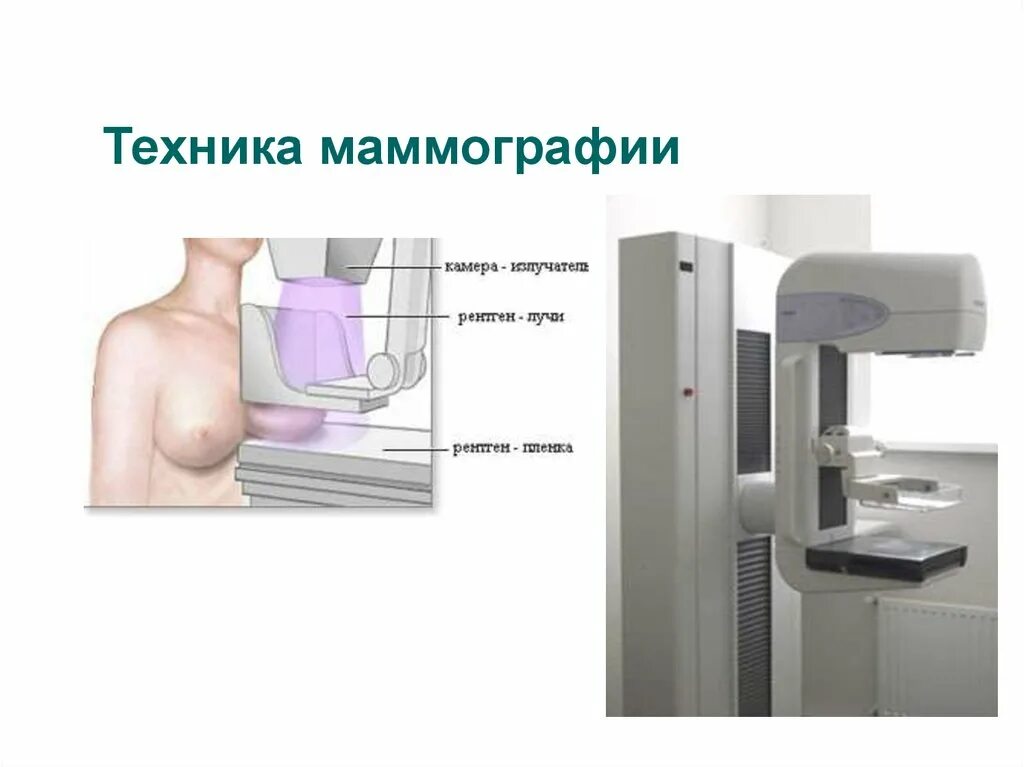 Маммография обязательно. Рентген молочных желез маммография аппарат. Маммограф рентгеновский "Маммо-4мт-плюс". Маммография в 2 проекциях рентгеновский. Маммография боковая проекция.