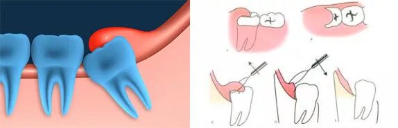 Перикоронарит воспаление. Перикоронарит зуба мудрости. Катаральный перикоронарит. Прорезается верхний зуб мудрости. Зубы болят и сверху и снизу